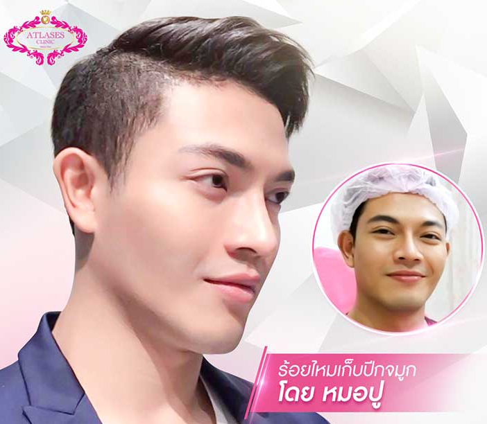 ร้อยไหมจมูกดีดปลาย