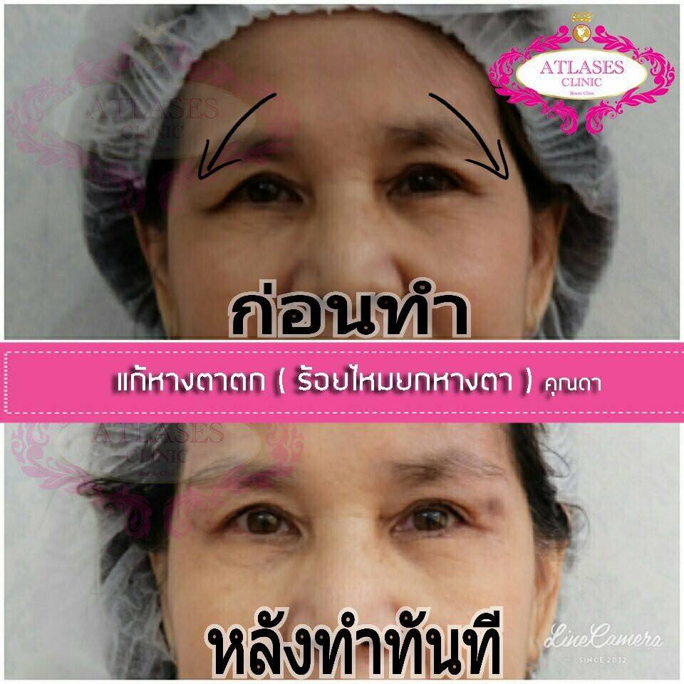 ร้อยไหมยกหางตา