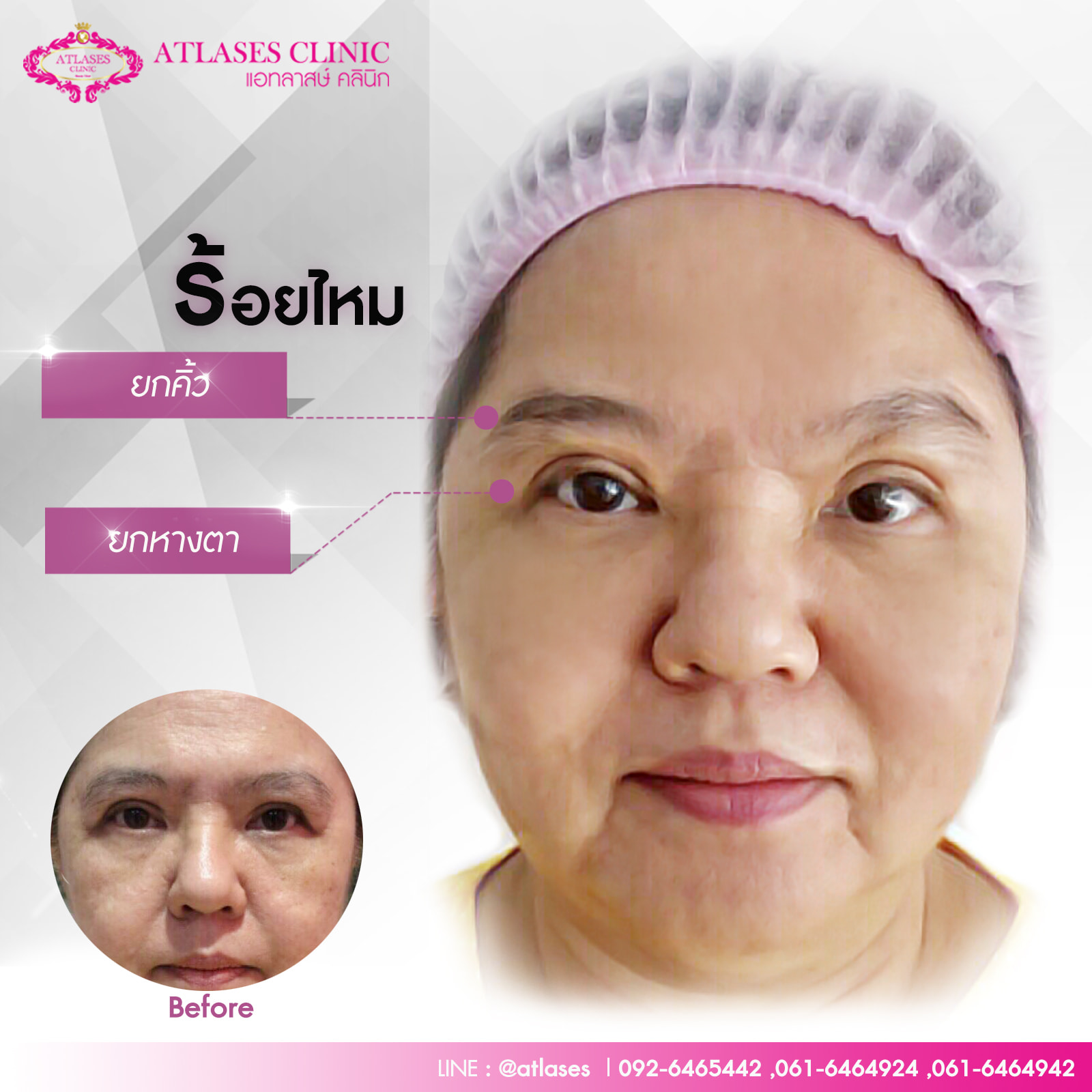 ร้อยไหมยกหางตา