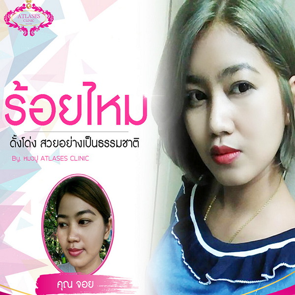 เคสรีวิวร้อยไหมจมูกดั้งโด่ง